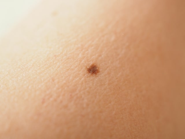 どうすればほくろのニキビを治すことができますか?